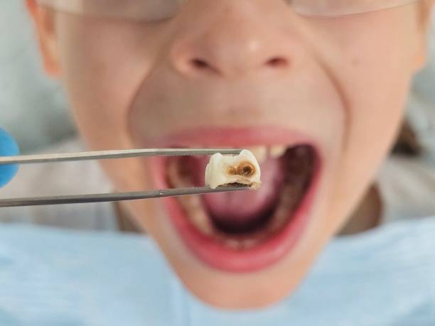 Best Emergency Wisdom Tooth Extraction in Elida, OH