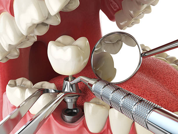 Best Emergency Cosmetic Dentistry (e.g., broken veneers) in Elida, OH